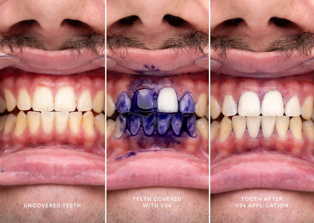 hismile™ V34 Tandencorrector