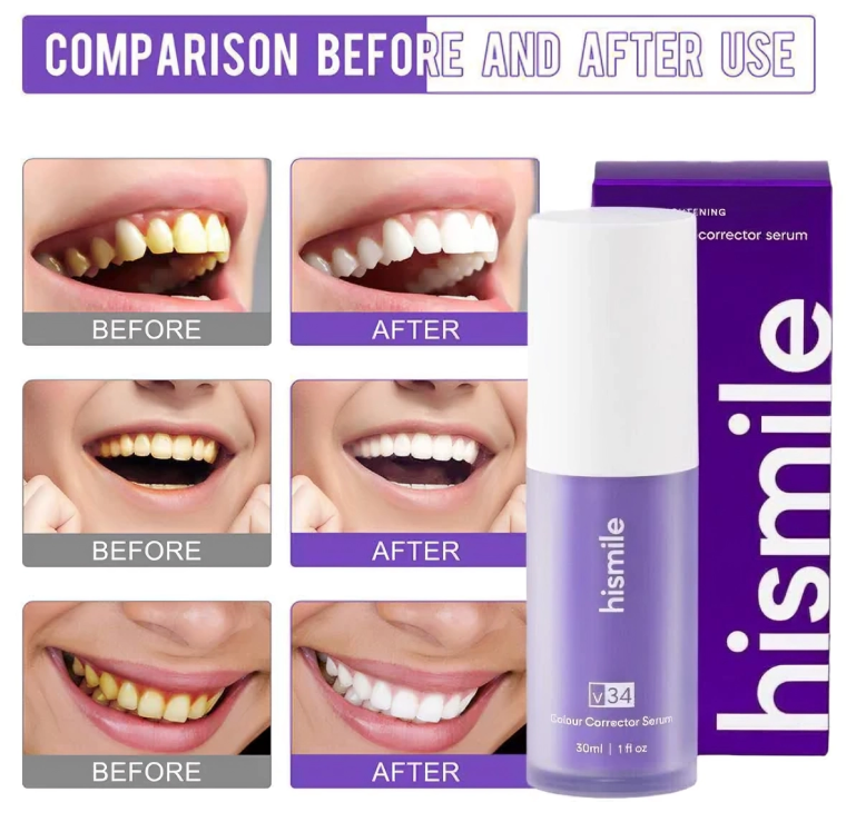 hismile™ V34 Teeth Whitening