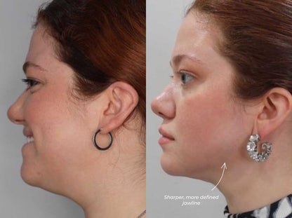 GlowLift™ IPL Device