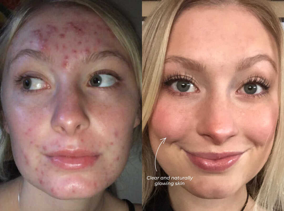 GlowLift™ IPL Device