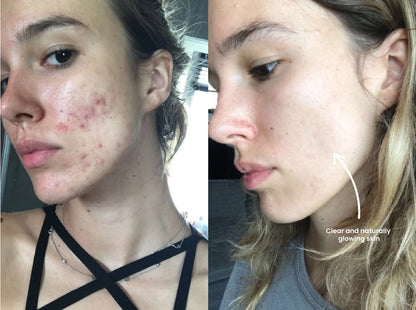 GlowLift™ IPL Device