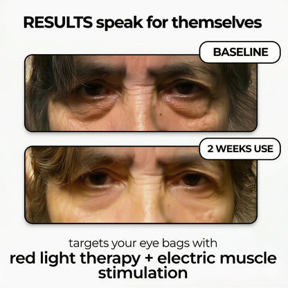 LumiEyes™ Advanced Red Light Eye Therapy